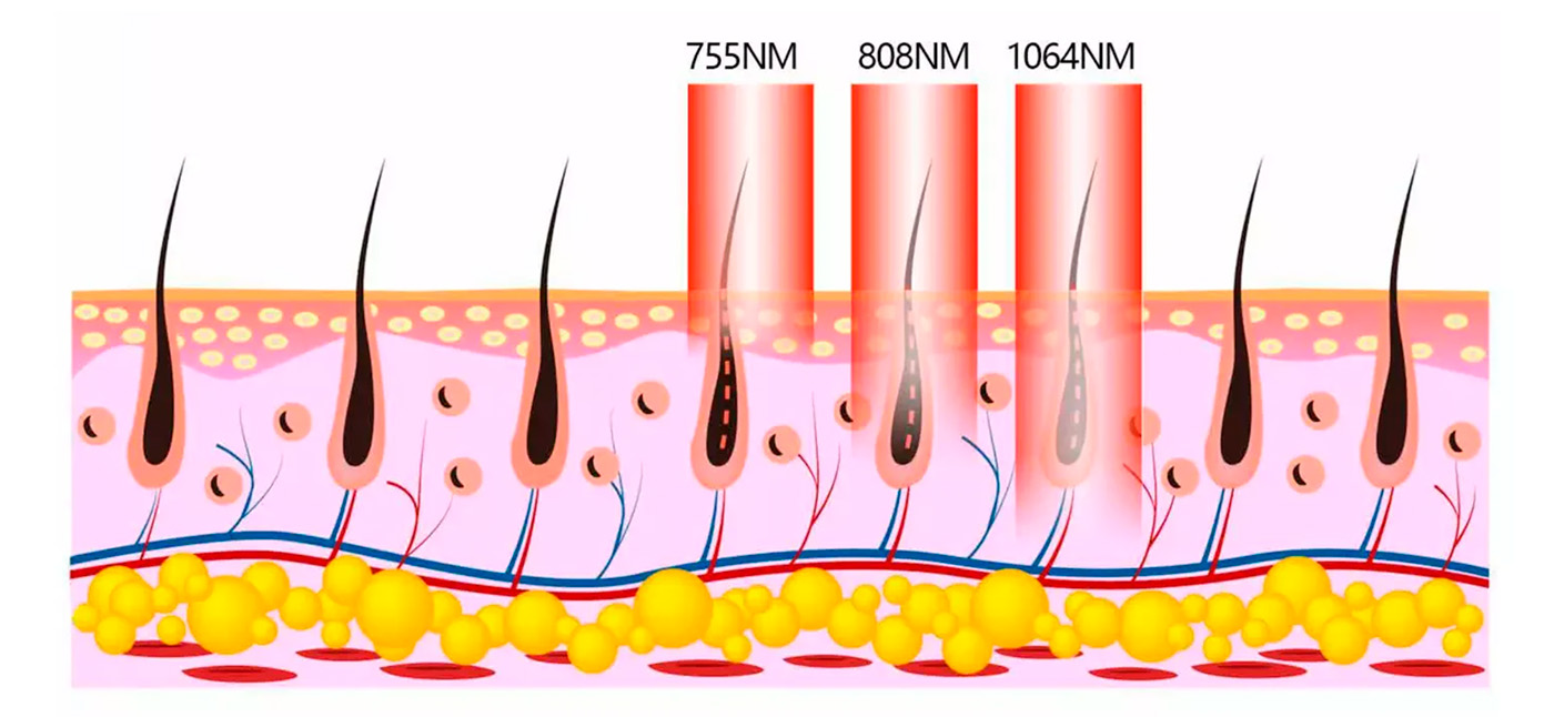 LASER DIODO NX1600 imagen